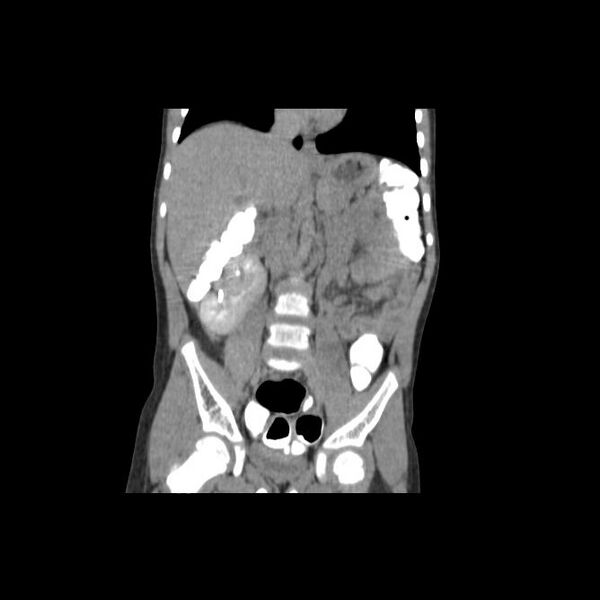 File:Bilateral renal malrotation (Radiopaedia 30901-31606 Coronal C+ delayed 4).jpg