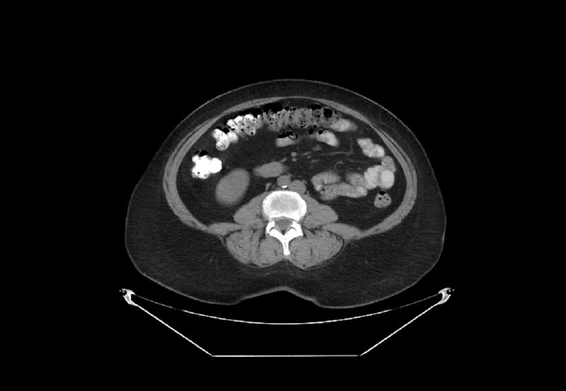 File:Bilateral urolithiasis with incidentally detected splenic artery aneurysm and left inferior vena cava (Radiopaedia 44467-48123 Axial non-contrast 31).jpg