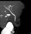 Bile leak from accessory duct(s) of Luschka post cholecystectomy (Radiopaedia 40736-43389 D 3).jpg