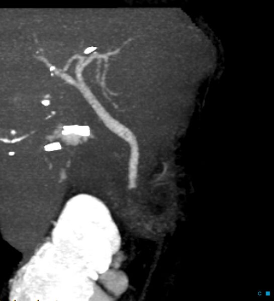 File:Bile leak from accessory duct(s) of Luschka post cholecystectomy (Radiopaedia 40736-43389 D 3).jpg