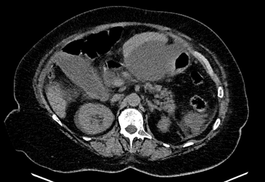 Biliary pancreatitis (Radiopaedia 72289-82823 Axial non-contrast 97).jpg
