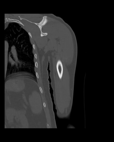 File:Bizarre parosteal osteochondromatous proliferation (Radiopaedia 84221-99501 Coronal bone window 17).jpg