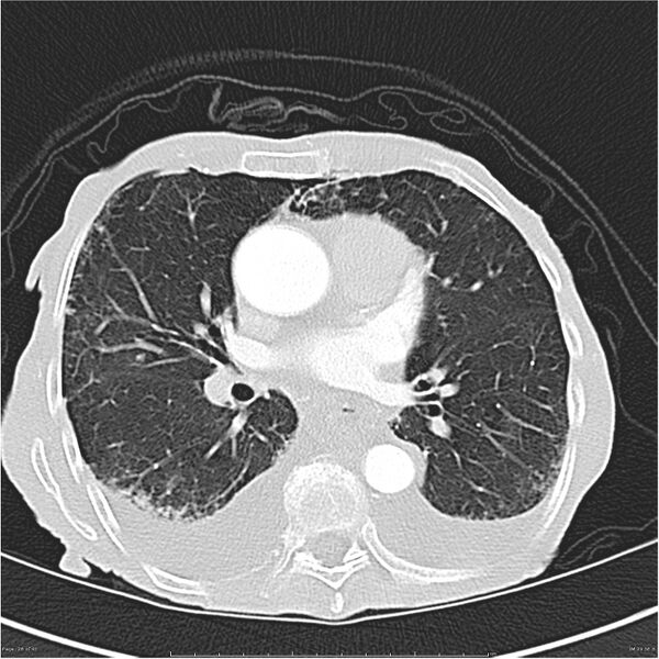 File:Boerhaave syndrome (Radiopaedia 26240-26362 Axial lung window 26).jpg