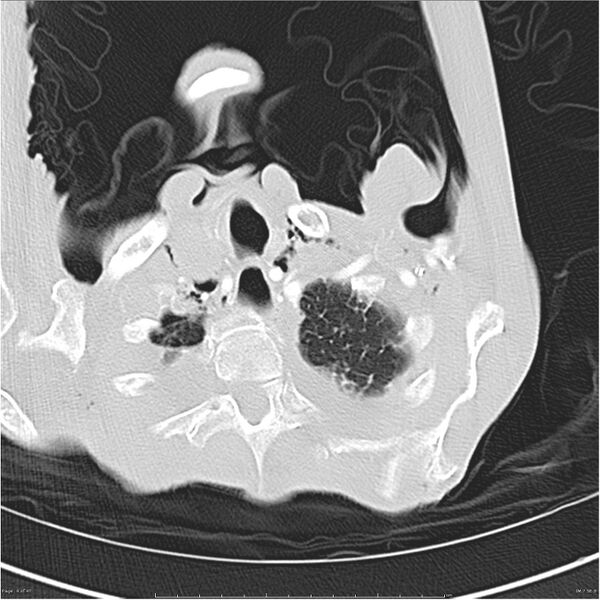 File:Boerhaave syndrome (Radiopaedia 26240-26362 Axial lung window 4).jpg