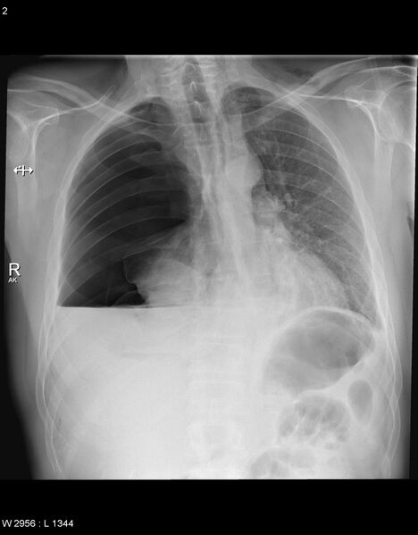 File:Boerhaave syndrome with tension pneumothorax (Radiopaedia 56794-63604 Frontal 1).jpg