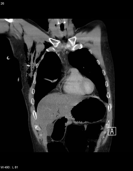 File:Boerhaave syndrome with tension pneumothorax (Radiopaedia 56794-63605 B 8).jpg