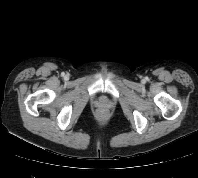 File:Bosniak renal cyst - type IV (Radiopaedia 22929-22953 C 70).jpg