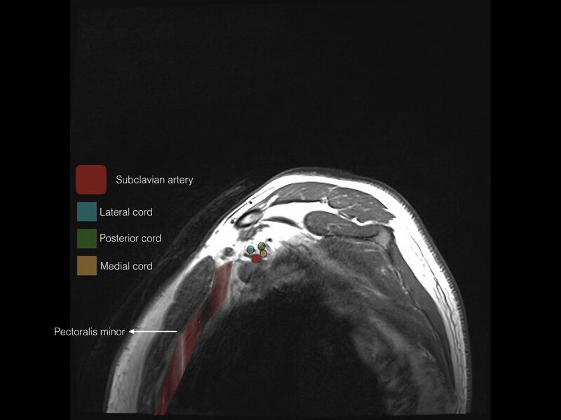 File:Brachial plexus anatomy (Radiopaedia 64414-73227 Sagittal T1 20).jpeg