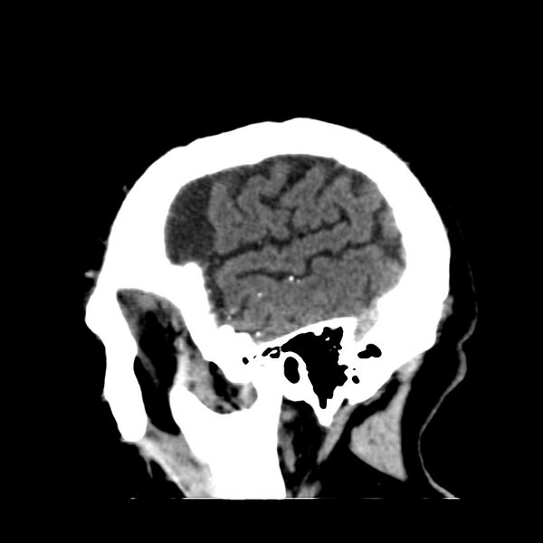 File:Brain Pantopaque remnants (Radiopaedia 78403-91048 C 48).jpg