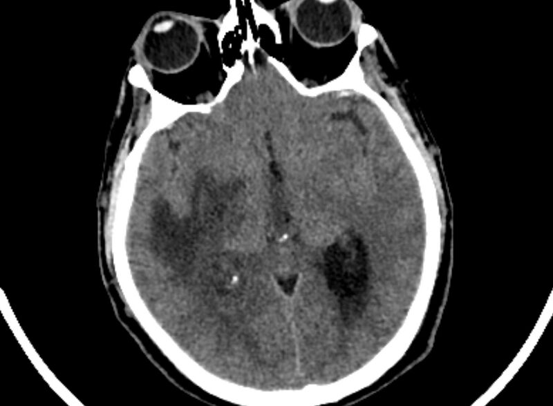 File:Brain abscess complicated by intraventricular rupture and ventriculitis (Radiopaedia 82434-96575 Axial non-contrast 33).jpg