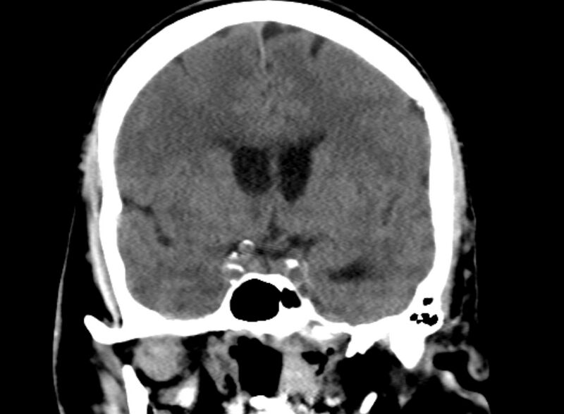 File:Brain abscess complicated by intraventricular rupture and ventriculitis (Radiopaedia 82434-96575 Coronal non-contrast 9).jpg