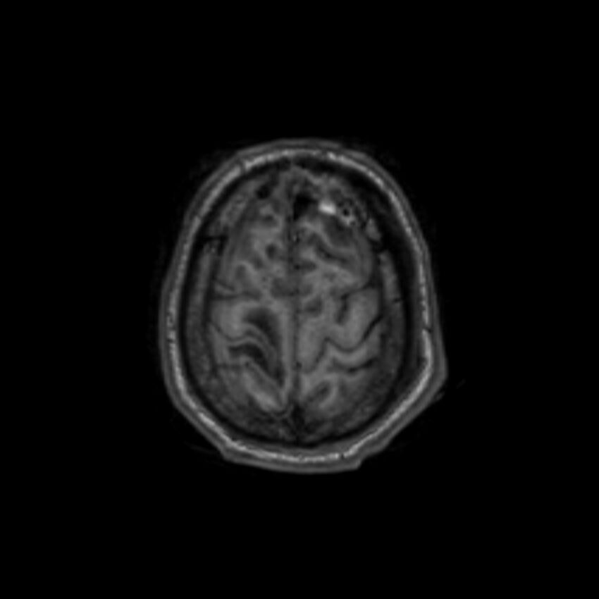 Brain abscess complicated by intraventricular rupture and ventriculitis (Radiopaedia 82434-96577 Axial T1 63).jpg