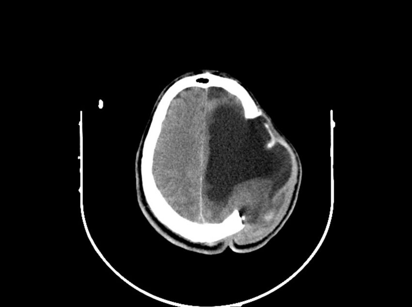 Brain injury by firearm projectile (Radiopaedia 82068-96088 A 166).jpg