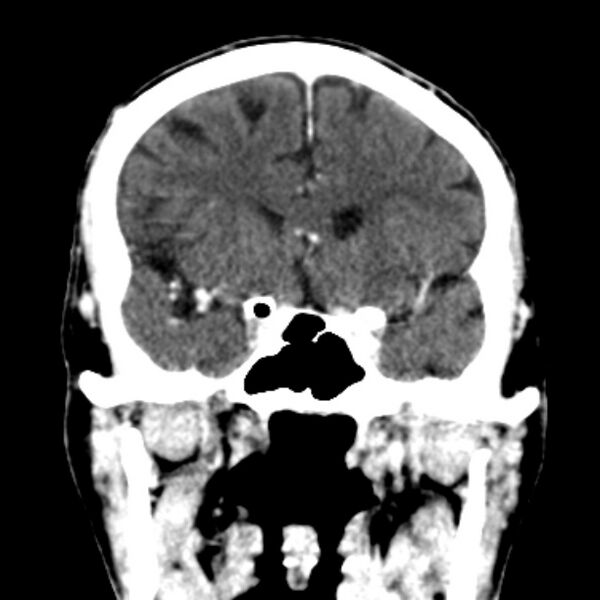 File:Brain metastases from lung cancer (Radiopaedia 27849-28092 Coronal C+ delayed 24).jpg