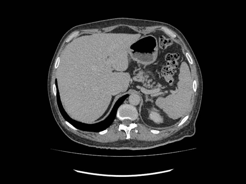 File:Brain metastases from renal cell carcinoma (Radiopaedia 42222-45328 Axial C+ delayed 1).jpg
