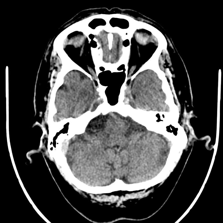 Brain metastasis (Radiopaedia 42617-45760 Axial non-contrast 8).jpg