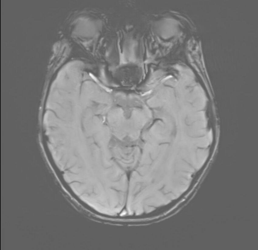 Brainstem glioma (Radiopaedia 70548-80674 Axial SWI 24).jpg