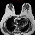 Breast carcinoma (multicentric multifocal in mammary Paget disease) (Radiopaedia 50966-56512 Axial T1 7).jpg