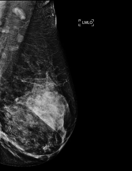 File:Breast hamartoma (Radiopaedia 65421-74481 B 1).jpg