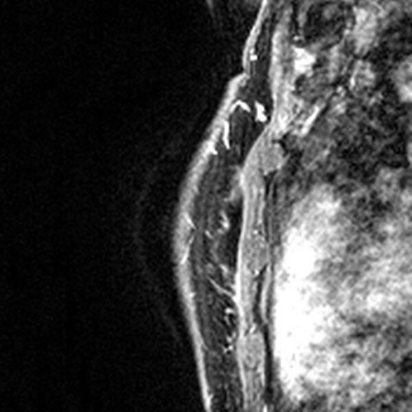 File:Breast implants - MRI (Radiopaedia 26864-27035 Sagittal T2 49).jpg