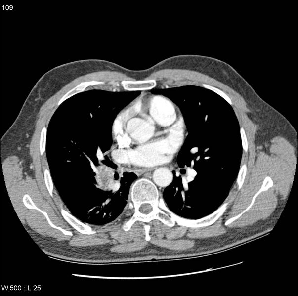File:Bronchial arterial aneurysm (Radiopaedia 22293-22330 A 6).jpg