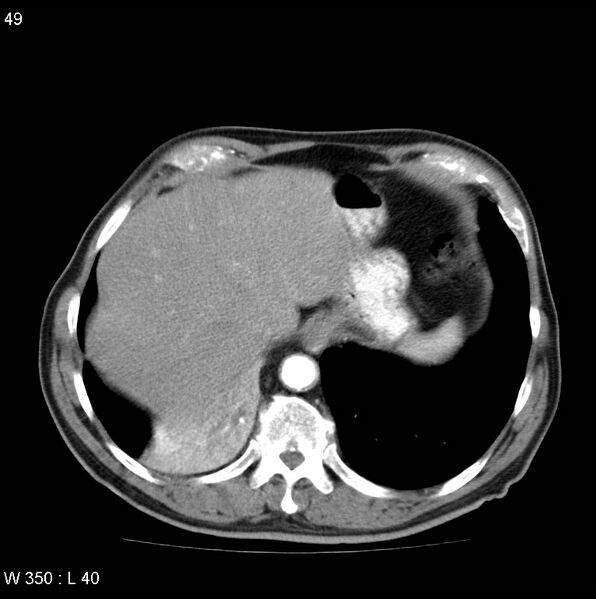 File:Bronchial carcinoid tumor with right lower lobe collapse (Radiopaedia 29060-29422 A 48).jpg