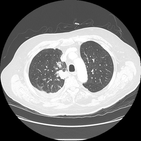 File:Bronchogenic adenocarcinoma and pulmonary embolism (Radiopaedia 9097-9806 Axial lung window 8).jpg