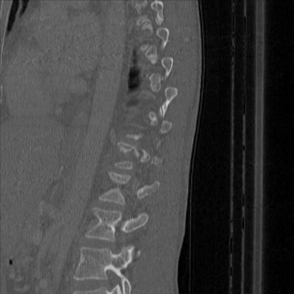 File:Bulging of paraspinal line in traumatic thoracal spinal compression fracture (Radiopaedia 29221-35872 Sagittal bone window 44).jpg