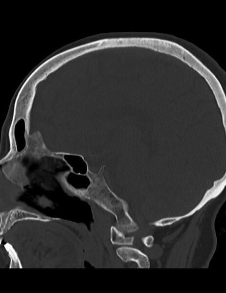 File:Burnt-out meningioma (Radiopaedia 51557-57337 Sagittal bone window 24).jpg