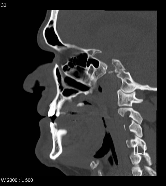 File:Calcification of the transverse band of the cruciform ligament (Radiopaedia 53063-59025 Sagittal bone window 7).jpg