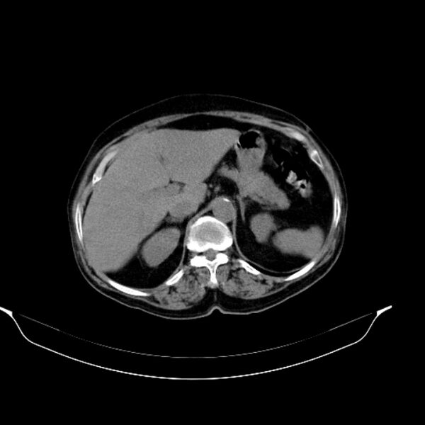 File:Calcified hydatid cyst (Radiopaedia 62000-70085 Axial non-contrast 33).jpg