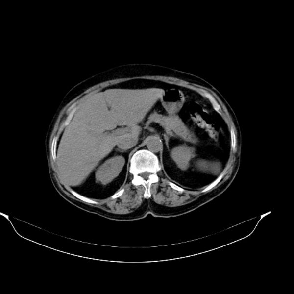 File:Calcified hydatid cyst (Radiopaedia 62000-70085 Axial non-contrast 34).jpg