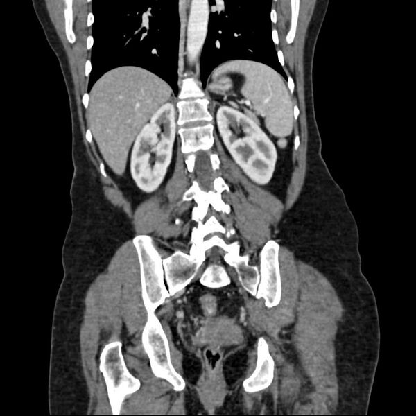 File:Calcified hydatid cyst of the liver (Radiopaedia 21212-21112 D 13).jpg