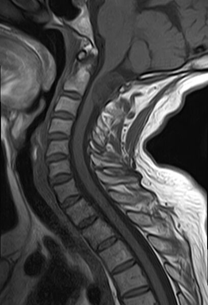 File:Calcified meningioma - cervical canal (Radiopaedia 70136-82468 Sagittal T1 8).jpg