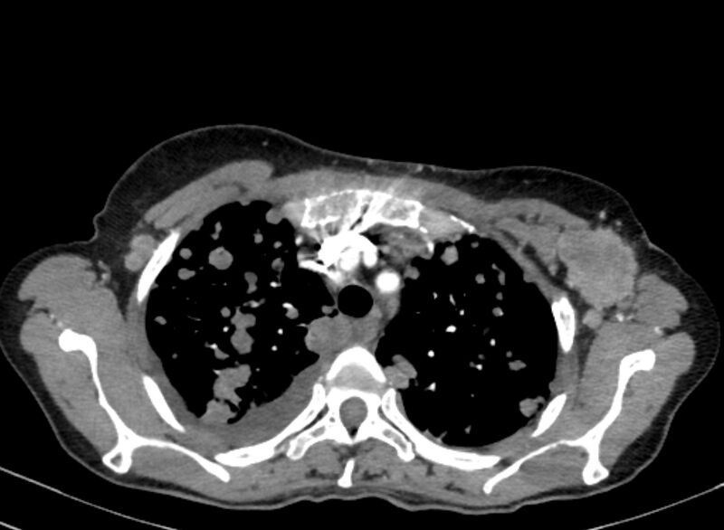 File:Cannonball metastases from breast cancer (Radiopaedia 91024-108569 A 32).jpg