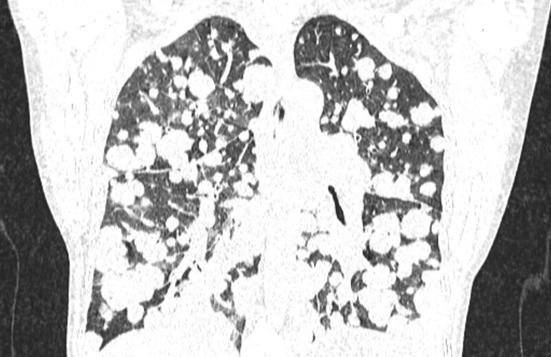 File:Cannonball metastases from breast cancer (Radiopaedia 91024-108569 Coronal lung window 91).jpg