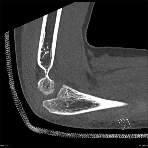 File:Capitellum fracture (Radiopaedia 23352-23426 Sagittal bone window 28).jpg