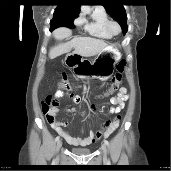 File:Carcinoid tumor of the ileum with metastasis to orbit (Radiopaedia 28165-28425 B 6).jpg