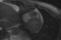 Cardiac hemangioma (Radiopaedia 31709-32631 E 36).jpg