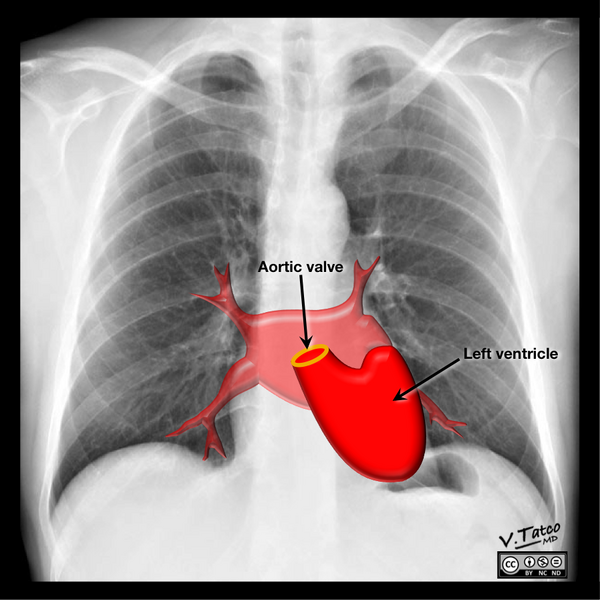 File:Cardiomediastinal anatomy on chest radiography (annotated images) (Radiopaedia 46331-50742 Q 6).png