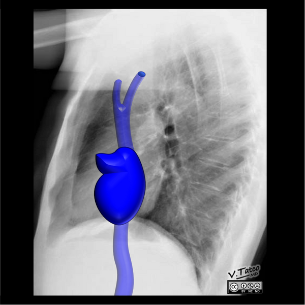 File:Cardiomediastinal anatomy on chest radiography (annotated images) (Radiopaedia 46331-50772 C 1).png