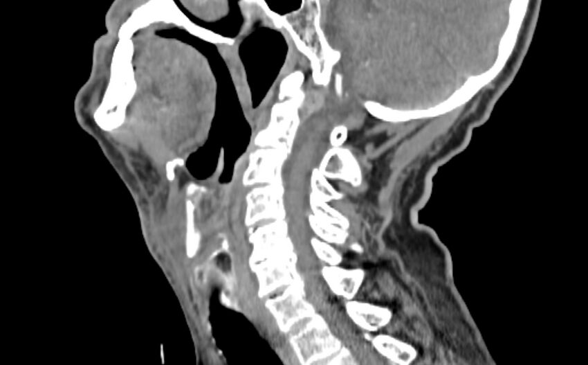 Carotid artery pseudoaneurysm (Radiopaedia 84030-99259 E 4).jpg