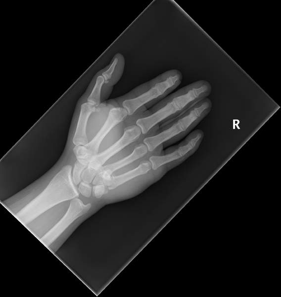 File:Carpometacarpal dislocation (Radiopaedia 33231-34262 Hand pa 1).png