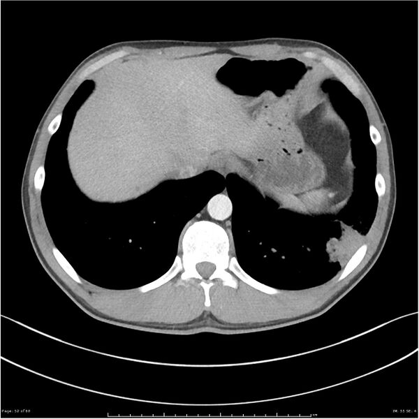 File:Cavitating lung cancer (Radiopaedia 25796-25945 C+ arterial phase 52).jpg