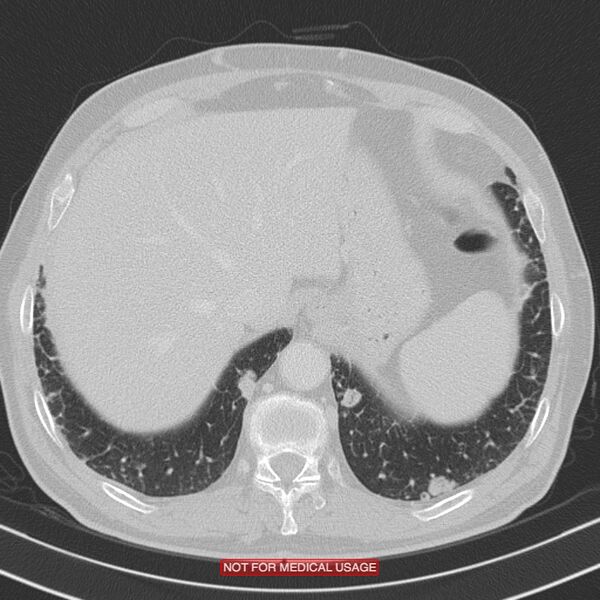 File:Cavitating pulmonary metastases (Radiopaedia 24920-25184 Axial lung window 21).jpg