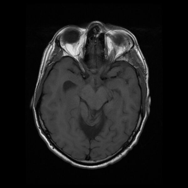 File:Central neurocytoma (Radiopaedia 67618-77021 Axial T1 10).jpg