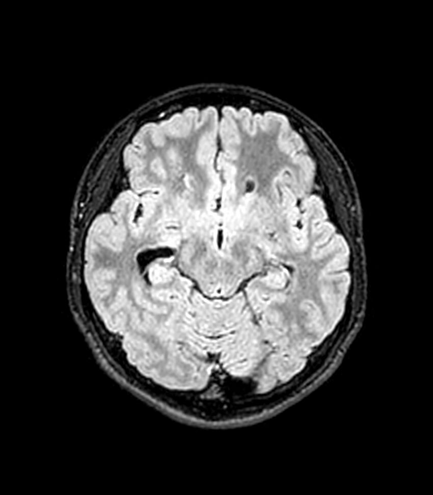 Central neurocytoma (Radiopaedia 79320-92380 Axial FLAIR 186).jpg