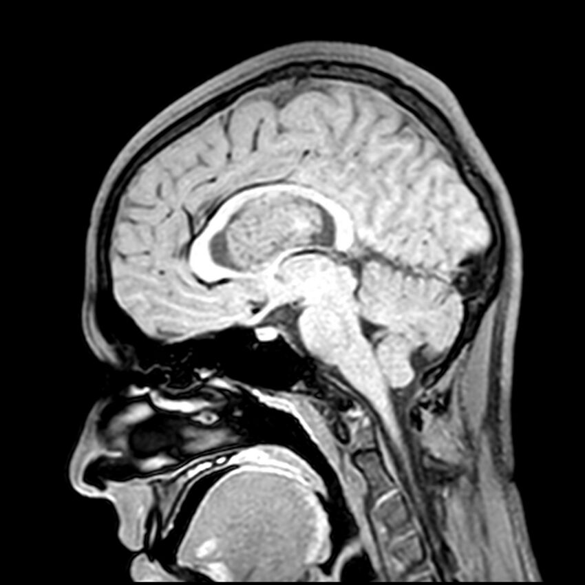Central neurocytoma (Radiopaedia 79320-92380 Sagittal T1 125).jpg