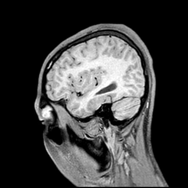 File:Central neurocytoma (Radiopaedia 79320-92380 Sagittal T1 201).jpg