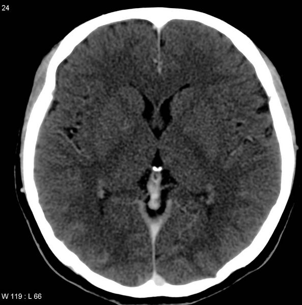 File:Cerebellar arteriovenous malformation (Radiopaedia 5220-36607 A 11).jpg